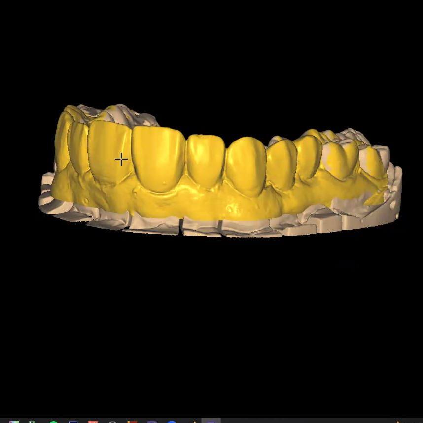 Celebrado El Curso Carillas Y Est Tica Anterior De Cad Cam Exocad